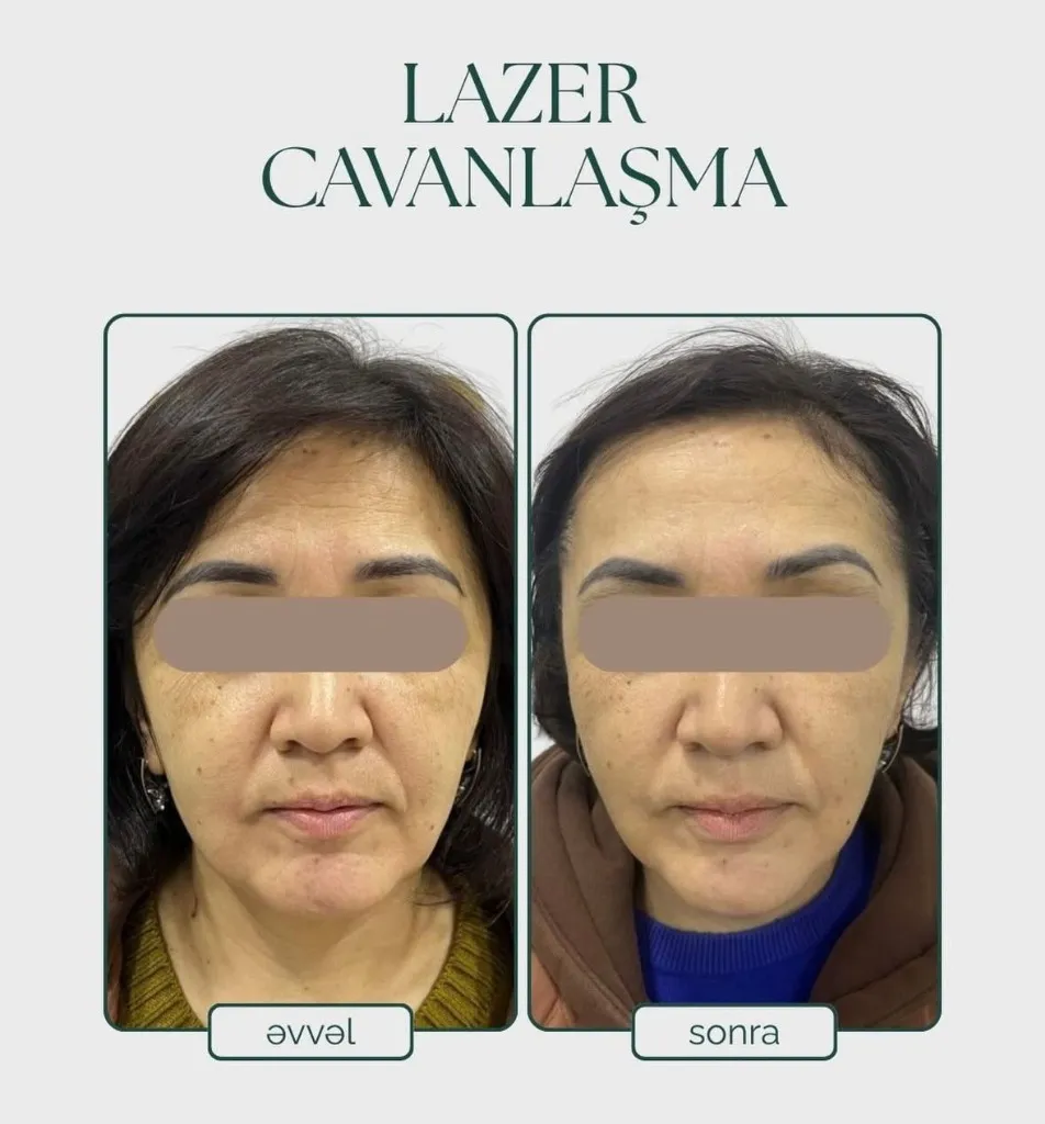 Lazer Cavanlaşma