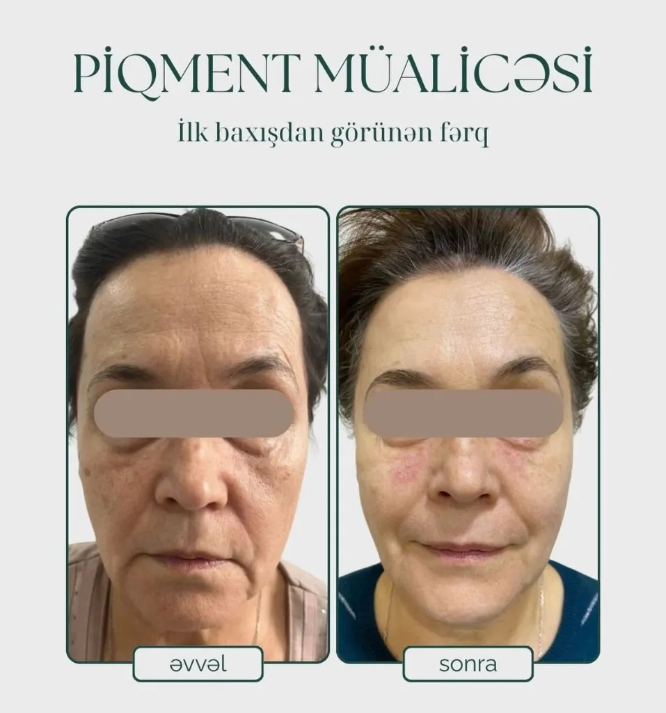 Piqment Müalicəsi