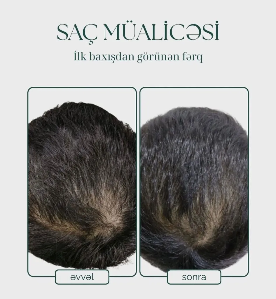 Saç Müalicəsi