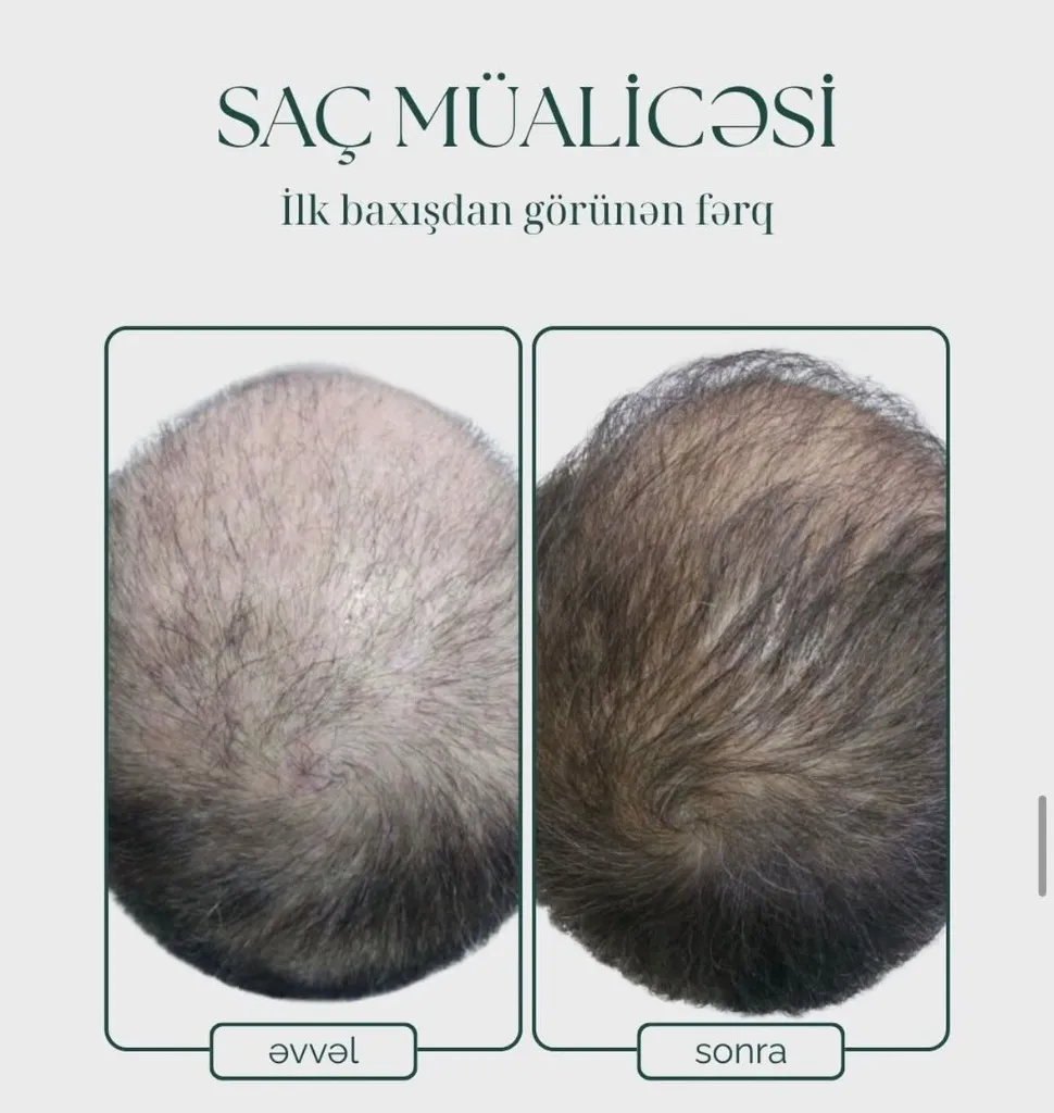 Saç Müalicəsi (2)